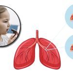Boswellia asthma