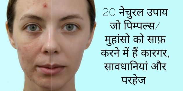 Home Remedies for Pimple