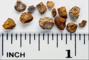 kidney stones